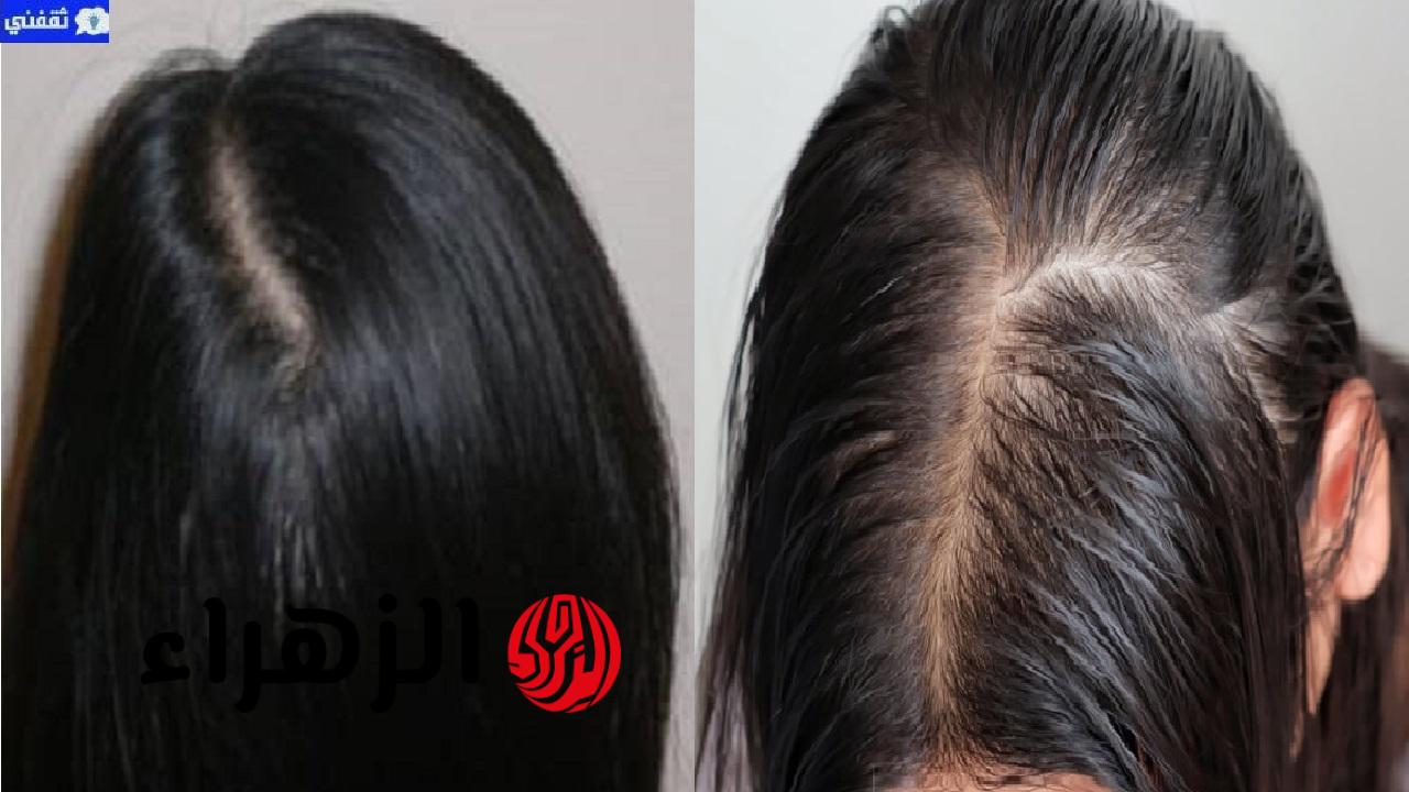 أقوى وصفة لانبات الشعر وملء الفراغات والعلاج الأمثل لتساقط الشعر