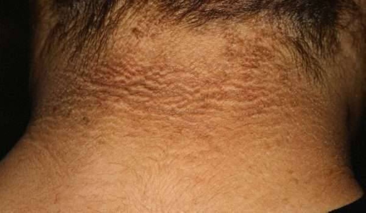 الشواك الأسود.. جرس إنذار لاضطراب خطير في الجسم