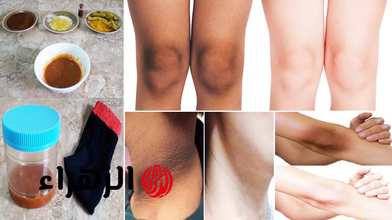 الوصفة الجبارة لتبييض الركب وإزالة الأسمرار والجلد الميت في دقائق لن تخجلي بعد اليوم