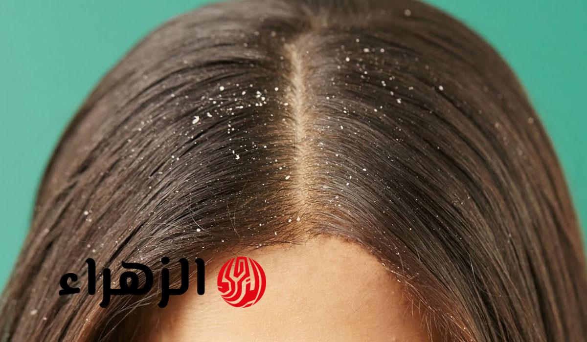 “جربيها وهتدعيلي”.. 4 حلول طبيعية تقضي على قشرة الرأس من أول مرة