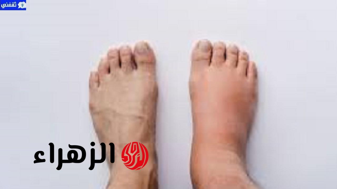 كيفية التخلص من الماء الزائد في الجسم وما هي اسباب احتباس الماء واضراره