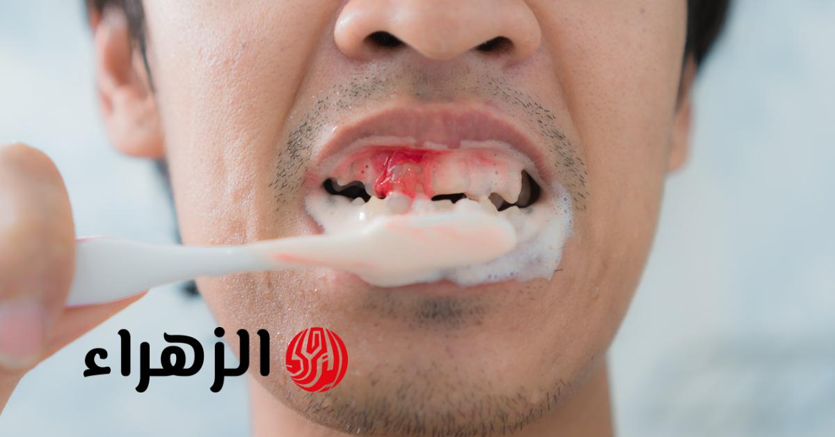 نزيف اللثة قد يكون علامة على نقص هذا الفيتامين بالجسم